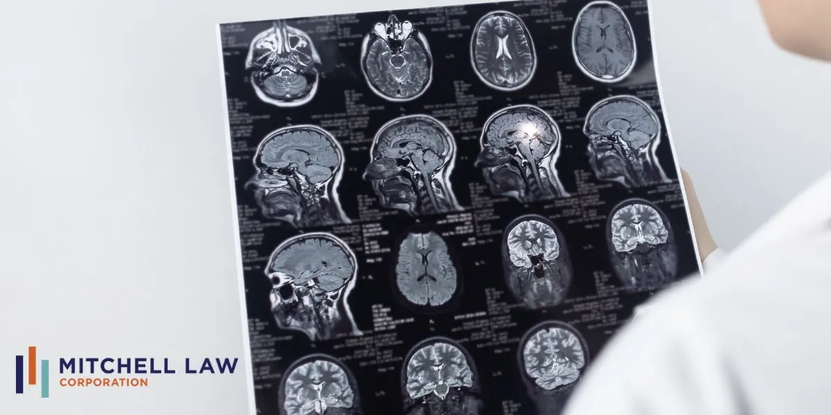 Los Angeles Brain Injury Attorney