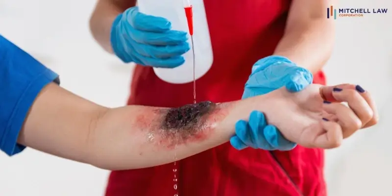 Best San Diego Burn Injury Lawyer